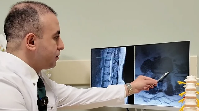 Bel Fıtığı Tedavisinde Ameliyat Son Çare Olmalı, Uyarılar Yapıldı